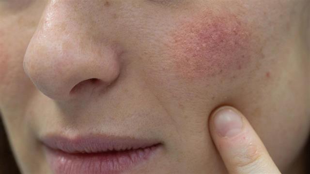 ECDC: Κρούσματα παρβοϊού Β19 σε 4 ευρωπαϊκές χώρες - Το εξάνθημα του χαστουκισμένου μάγουλου