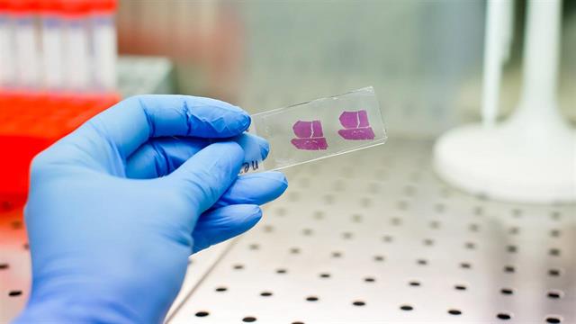 Nέα προσέγγιση για τον καρκίνο του ήπατος που δεν αντιμετωπίζεται εύκολα