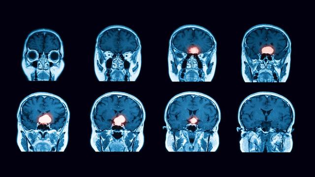 Όγκοι της υπόφυσης: Πού πρέπει να στοχεύει η χειρουργική θεραπεία