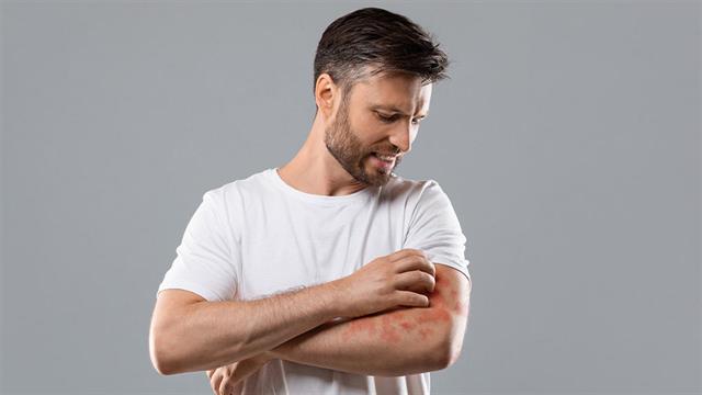 Eκτη ένδειξη για το Dupilumab στις ΗΠΑ