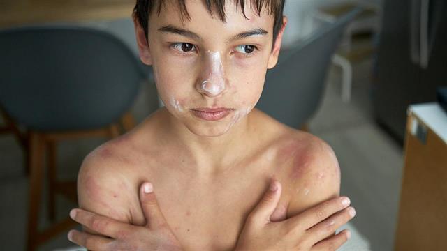 Στιγματισμό βιώνουν τα παιδιά  με χρόνιες δερματικές παθήσεις [μελέτη]