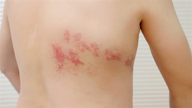 Διαβήτης: Προσοχή στον έρπητα ζωστήρα!