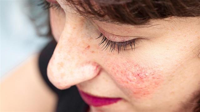 Ροδόχρους ακμή: Αποτελεσματική η  χαμηλή δόση ισοτρετινοΐνης