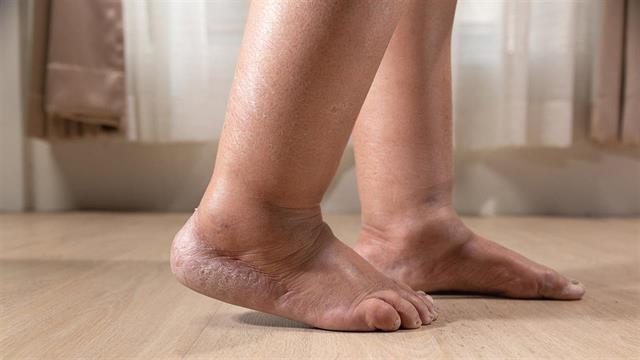 Νέα συσκευή για την καρδιακή ανεπάρκεια θα μπορούσε να προλαμβάνει τις νοσηλείες