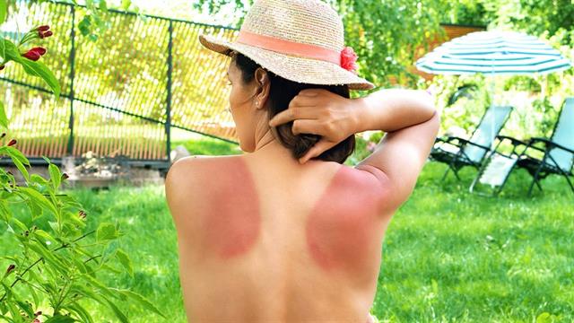 Ενας στους τρεις Αυστριακούς έχει ήδη υποστεί ηλιακό έγκαυμα [έρευνα]