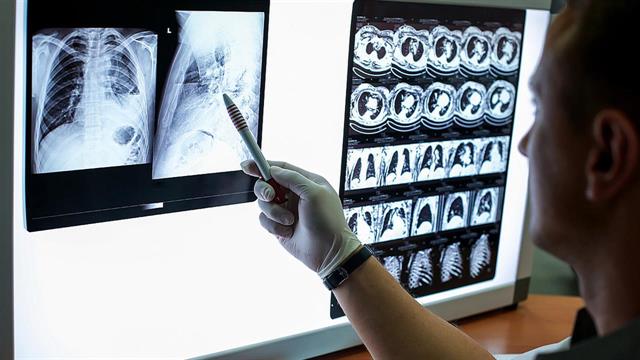 Kαρκίνος του πνεύμονα: Συνδυαστική θεραπεία μειώνει τον πολλαπλασιασμό των καρκινικών κυττάρων