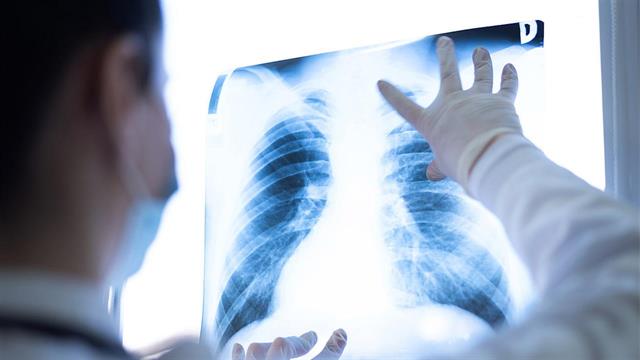 Ραδιοφάρμακο κατά του καρκίνου του πνεύμονα