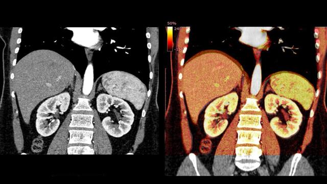 Το νεφριτικό σύνδρομο μπορεί να είναι αυτοάνοσο