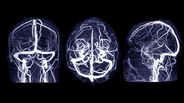Στατίνες και μετφορμίνη είναι πιθανό να μειώνουν τον κίνδυνο ανευρύσματος στον εγκέφαλο [μελέτη]