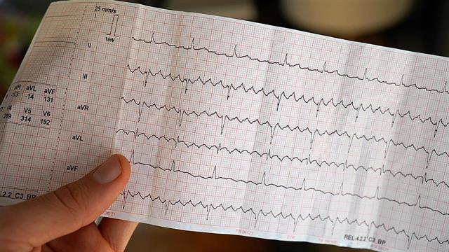 Άνθρωποι με κολπική μαρμαρυγή κινδυνεύουν από άνοια [μελέτη]