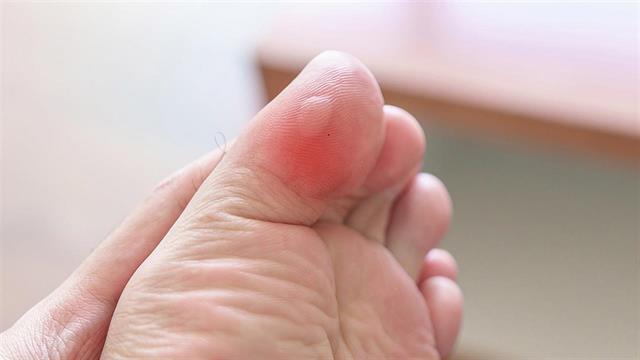 Φουσκάλες στα πόδια: Πώς τις αποφεύγω