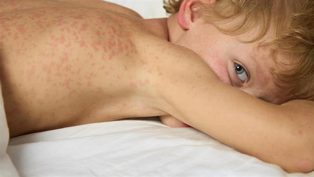 ECDC: 23 τα κρούσματα ιλαράς στην Ελλάδα τo 2024 - Αναμένεται περαιτέρω αύξηση