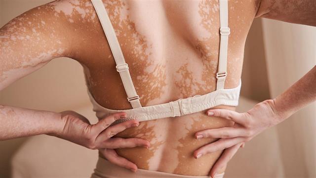 Q&A: Απαντήσεις στις πιο συχνές ερωτήσεις για τη λεύκη