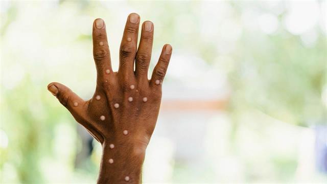 Μετάλλαξη της ευλογιάς των πιθήκων εξαπλώνεται στο Κονγκό