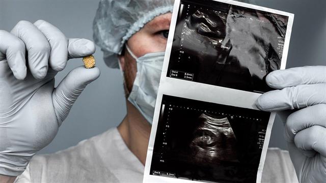 Πέτρες στα νεφρά: Νέα μέθοδος αναγνωρίζει τον τύπο τους χωρίς χειρουργική επέμβαση