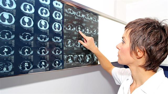 Η ΕΕ εγκρίνει το dupilumab της Sanofi για τους πνεύμονες του καπνιστή