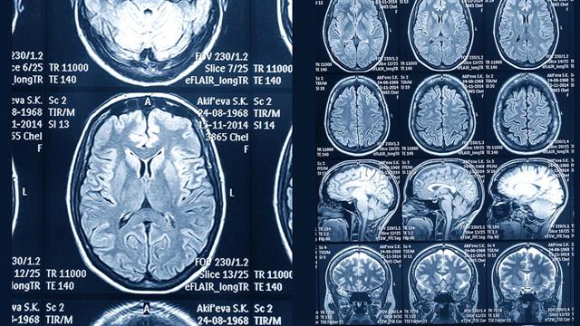 Μπορούμε να επηρεάσουμε την ηλικία του εγκεφάλου;