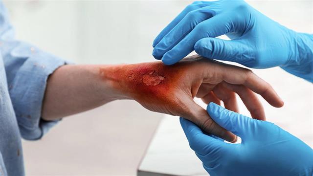 Έρευνα: Ποιοι παθαίνουν πιο συχνά εγκαύματα