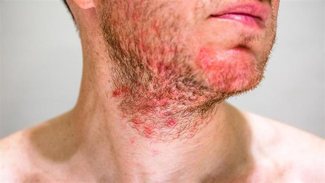 Σμηγματορροϊκή δερματίτιδα: Πώς να την αντιμετωπίσετε