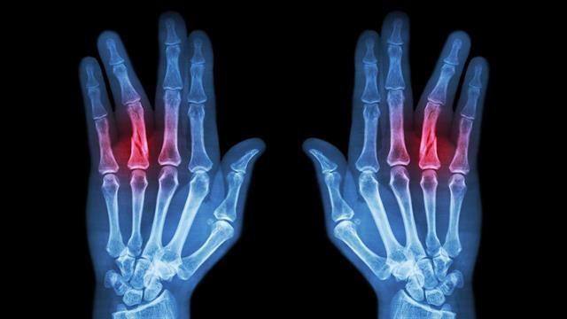 Πρώτη επιλογή η μεταφορά μοσχευμάτων με διατιτρώσες αρτηρίες για την κάλυψη οστών