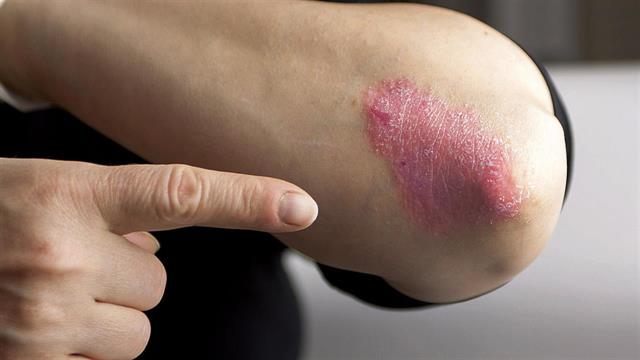 Η έκθεση στην ατμοσφαιρική ρύπανση συνδέεται με εμφάνιση ψωρίασης [μελέτη]