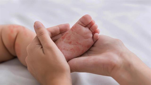 ECDC: 6 νέα κρούσματα ιλαράς στην Ελλάδα - 29 από την αρχή του έτους