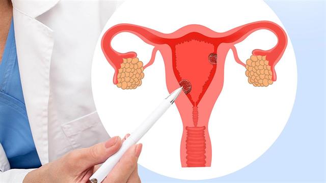 Ασυμπτωματικοί ενδομητρικοί πολύποδες και εμμηνόπαυση