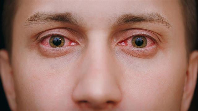 Μάτια: Προσοχή στον καπνό από τις φωτιές