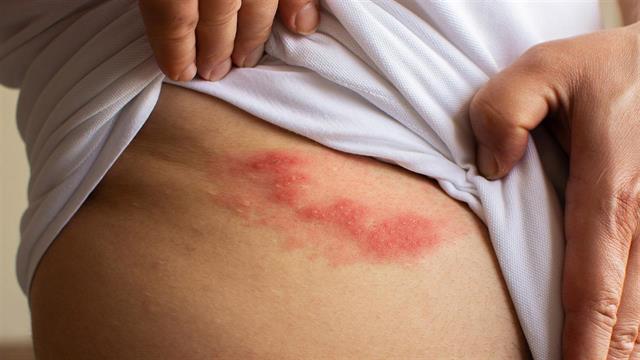 ‘Ερπης ζωστήρας και γνωστική εξασθένηση [μελέτη]