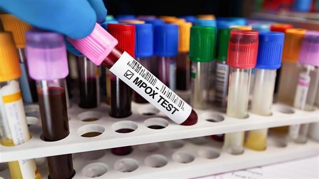 Πρώτο κρούσμα mpox στο Πακιστάν