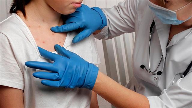 Ευλογιά των πιθήκων: Τι σημαίνει το υψηλότερο επίπεδο συναγερμού του ΠΟΥ