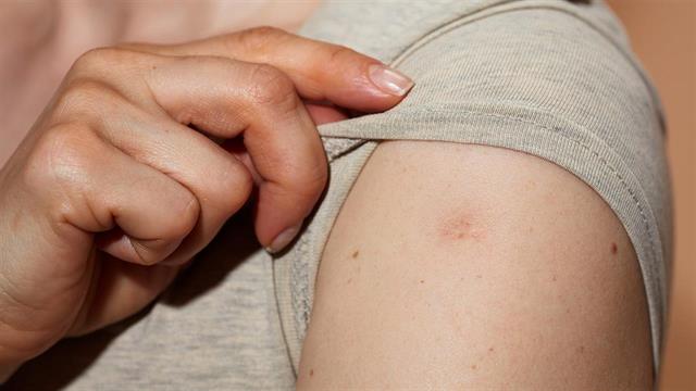 Ένας θάνατος από ευλογιά των πιθήκων στην Ακτή του Ελεφαντοστού - Συνολικά 28 κρούσματα