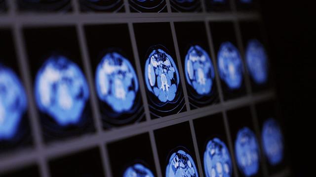 Νέο θεραπευτικό μονοπάτι για τη θεραπεία της μεταβολικής ηπατικής νόσου