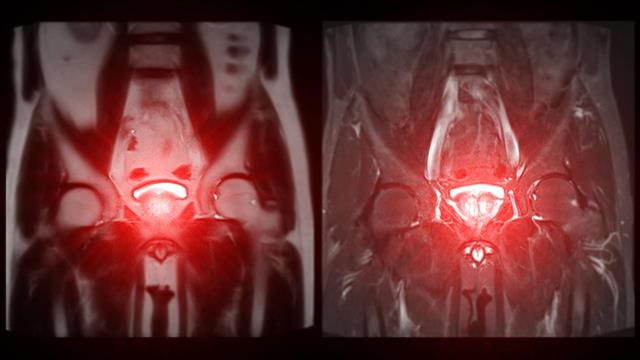Fusion διαπερινεϊκή βιοψία - Η πιο εξελιγμένη μέθοδος για τη διάγνωση του καρκίνου του προστάτη