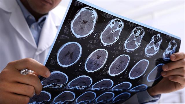 Πολλαπλή σκλήρυνση: Έρευνα εντόπισε βιοδείκτες που προβλέπουν την επιδείνωση της αναπηρίας