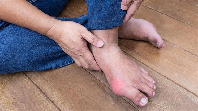 Γενετικοί παράγοντες είναι η κύρια αιτία της ουρικής αρθρίτιδας [μελέτη]