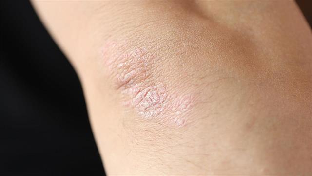 Καθαρό ή σχεδόν καθαρό δέρμα σε ανθρώπους με κατά πλάκας ψωρίαση έδωσε χάπι σε δοκιμή τελικού σταδίου