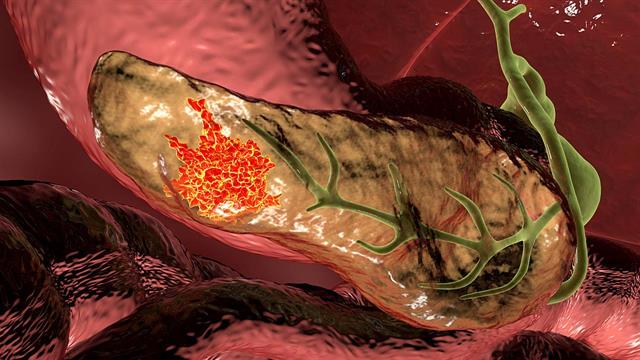 Καρκίνος παγκρέατος: Aύξηση της επίπτωσης σε άτομα νεαρής ηλικίας