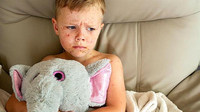 ECDC: 35 κρούσματα ιλαράς στην Ελλάδα το εννεάμηνο - 11 τον Φεβρουάριο