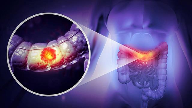 O FDA ενέκρινε θεραπευτική αγωγή για τον καρκίνο παχέος εντέρου