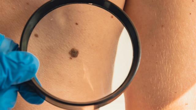 Ιός συρρικνώνει τον καρκίνο του δέρματος πριν από τη χειρουργική αφαίρεση