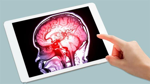 Σημαντική ανακάλυψη για το εγκεφαλικό επεισόδιο