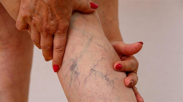 Κιρσοί: Μύθοι και αλήθειες