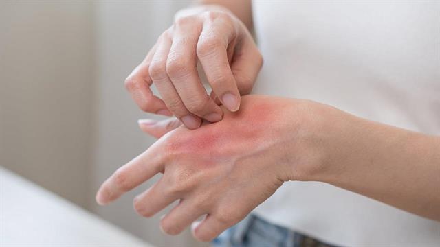 Έκζεμα: Γιατί δεν πρέπει να ξύνει κάποιος το εξάνθημά του [μελέτη]