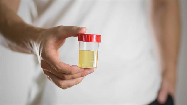 Eξέταση ούρων για καρκίνο προστάτη - Στο σπίτι η συλλογή δείγματος