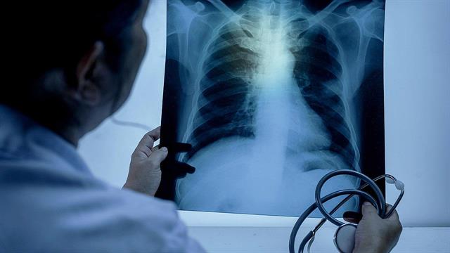 Κυστική ίνωση: Η Ελλάδα στον ευρωπαϊκό χάρτη των κλινικών μελετών