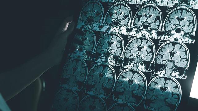 Ομοιότητες στους εγκεφάλους ασθενών με long CoViD και χρόνια κόπωση [μελέτη]