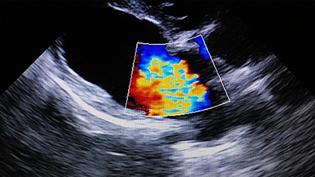 Εστάλησαν τα πρώτα SMS για δωρεάν εξετάσεις καρδιαγγειακών νοσημάτων