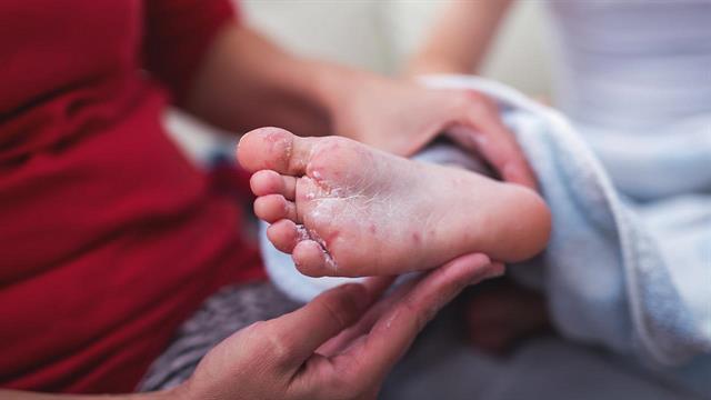 Σε ύφεση ιλαρά και ερυθρά στην Ελλάδα - ECDC: Έξαρση στην Ευρώπη - Οδηγίες