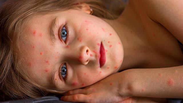 Συναγερμός ΠΟΥ για τα κρούσματα ιλαράς στην Ευρώπη το 2024